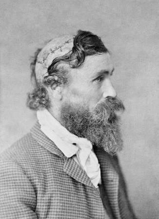 Robert McGee%2c scalped as a child by Sioux Chief Little Turtle in 1864